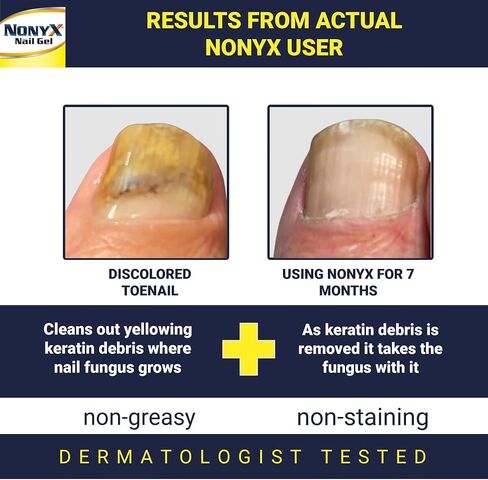 NONYX Fungal Nail Clarifying Gel | Rids Nails of Fungus by Removing Keratin Debris Where Nail Fungus Grows | 90% of Toenails Improved Using this Toenail Fungus Treatment | 4 oz in Saudi Arabia