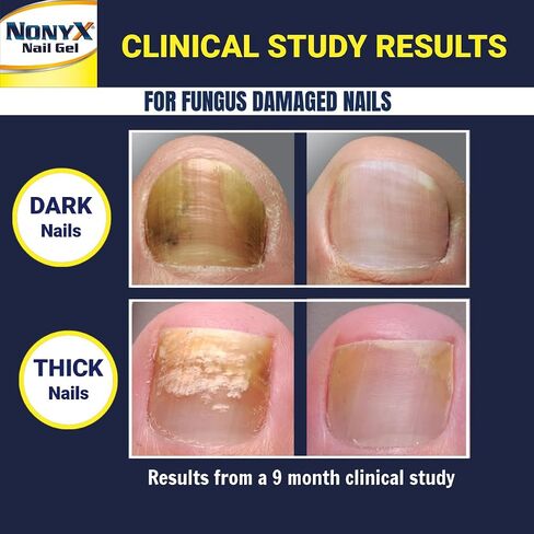 NONYX Fungal Nail Clarifying Gel | Rids Nails of Fungus by Removing Keratin Debris Where Nail Fungus Grows | 90% of Toenails Improved Using this Toenail Fungus Treatment | 4 oz in Saudi Arabia
