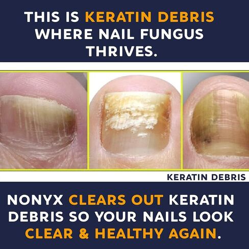 NONYX Fungal Nail Clarifying Gel | Rids Nails of Fungus by Removing Keratin Debris Where Nail Fungus Grows | 90% of Toenails Improved Using this Toenail Fungus Treatment | 4 oz in Saudi Arabia