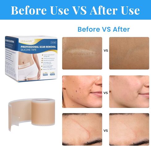 Silicone Scar Sheets, Silicone Scar Tape Roll (60"x1.6"), Professional Scars Removal Treatment, Scar Silicone Strips, Reusable Silicone Scar Strips Type for Keloid, C-Section, Surgery, Keloid, Acne in Saudi Arabia