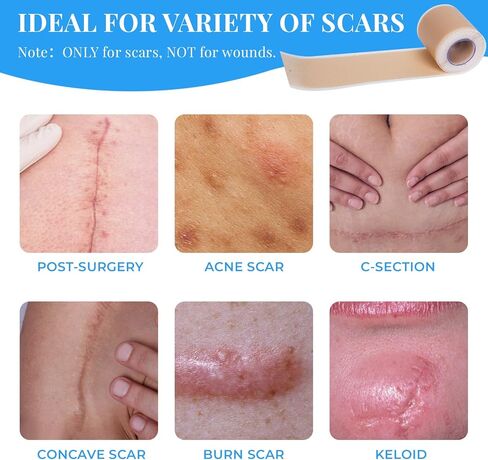 Silicone Scar Sheets, Silicone Scar Tape Roll (60"x1.6"), Professional Scars Removal Treatment, Scar Silicone Strips, Reusable Silicone Scar Strips Type for Keloid, C-Section, Surgery, Keloid, Acne in Saudi Arabia