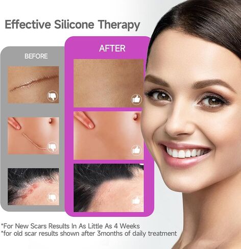 Advanced Scar Cream Silicone Scar Gel Scar Removal Cream for Face, Body, Surgical, C-section, Stretch Marks, Acne, Injury, Burns, Keloids, Old and New Scars 1.7 oz(50g) in Saudi Arabia