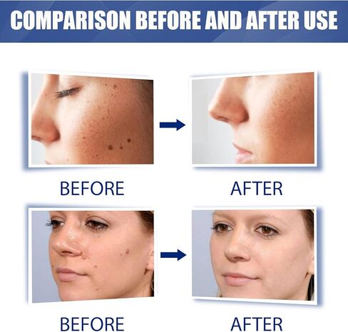 Wart Remover Freeze Off,with Salicylic Acid for Removal of Common and Plantar Warts,1 Pack Fast-Acting Wart Remover in Saudi Arabia