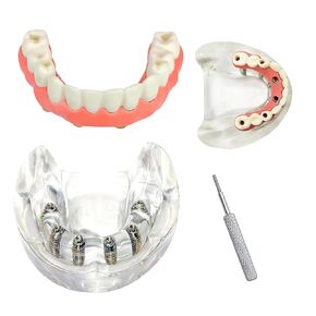 Dental Overdenture Inferior Model, 6 Nail Dental Implant Model Removable Demo Model for Researching Medical Dentist Teaching Studying