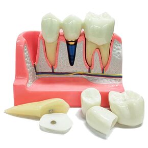 Dental Implant Model 4 Times Implant Teeth Model, Analysis Crown Bridge Removable Model Dentistry Stutent Study and Dentist Teaching.