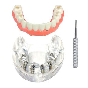 Dental Mandibular Removable Overdenture Model,Dental Typodont Implant Restoration Model with 6 implants for Dental Students&Patient Education.