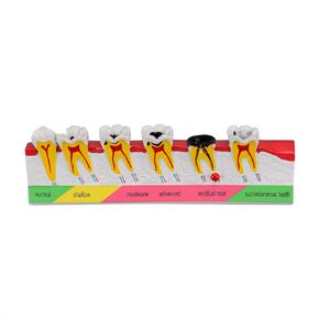 Dental Caries Developing Model, Dental Teeth Model for Dental Tooth Anatomy Study, Doctor-Patient and Oral Care Education