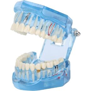 Disease Teeth Model, Acrylic Blue Transparent Teaching Demonstration Simulation Dental Teeth Model, Gingiva Visible Anatomic Teaching Studying Model