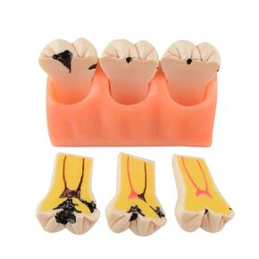 Dental Caries Teeth Model 4 Times Dental Tooth Decay Model Caries Bilateral Comparison Pathology Model Teeth for Dental Education Supplies, Tooth Pathology Display