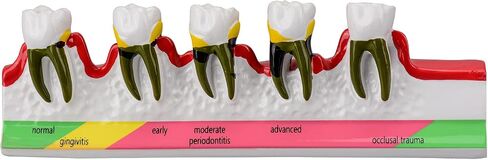 Dental Caries Developing Model, Dental Teeth Model for Dental Tooth Anatomy Study, Doctor-Patient and Oral Care Education in Kuwait