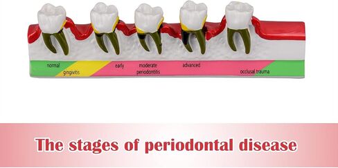 Dental Caries Developing Model, Dental Teeth Model for Dental Tooth Anatomy Study, Doctor-Patient and Oral Care Education in Kuwait