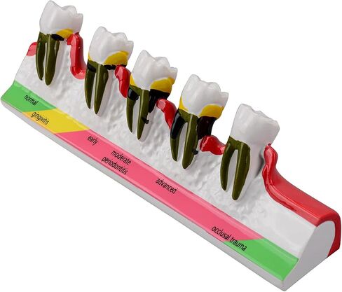 Dental Caries Developing Model, Dental Teeth Model for Dental Tooth Anatomy Study, Doctor-Patient and Oral Care Education in Kuwait
