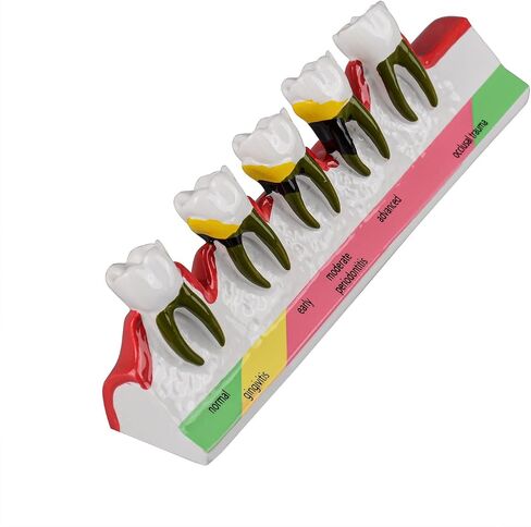 Dental Caries Developing Model, Dental Teeth Model for Dental Tooth Anatomy Study, Doctor-Patient and Oral Care Education in Kuwait