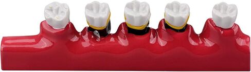 Dental Caries Developing Model, Dental Teeth Model for Dental Tooth Anatomy Study, Doctor-Patient and Oral Care Education in Kuwait