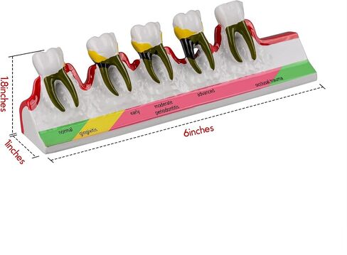 Dental Caries Developing Model, Dental Teeth Model for Dental Tooth Anatomy Study, Doctor-Patient and Oral Care Education in Kuwait