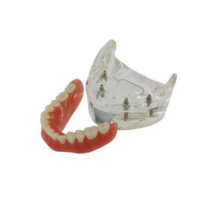 Dental Implant Teeth Demo Model Mandibular Overdenture with 4 Implants