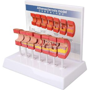 7PCS Artery Anatomy Model, Anatomical Vessel Atherosclerosis Thrombus Vascular Model for Doctors Office Educational Tool Study Supplies