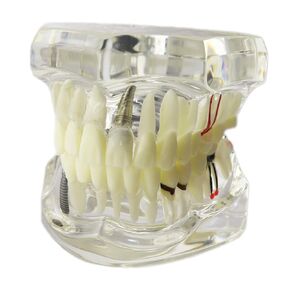 Dental Implant Disease Teeth Model with Restoration and Bridge Tooth for Teaching and Studying