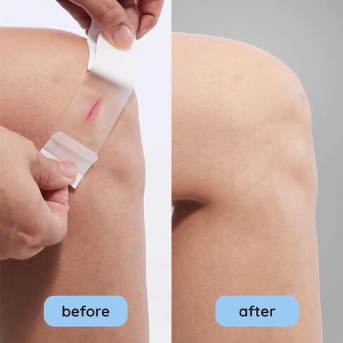 Superband Hydrocolloid ضمادات مضادة للماء خلط الجرح بواسطة Makeitskin | شفاء رفيع وسريع ، ندبة تقلل من الخدوش ، القطع ، الحروق ، البثور ، طفح الطريق in Saudi Arabia