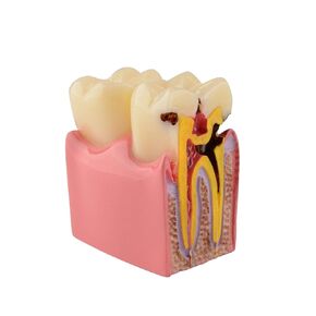 Dental Tooth Decay Model 6 Times Dental Caries Teeth Model Caries Bilateral Comparison Pathology Model Teeth for Dental Education Supplies, Tooth Pathology Display