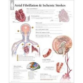 Atrial Fib & Ischemic Strokes Wall Chart (Anatomical Wall Charts)