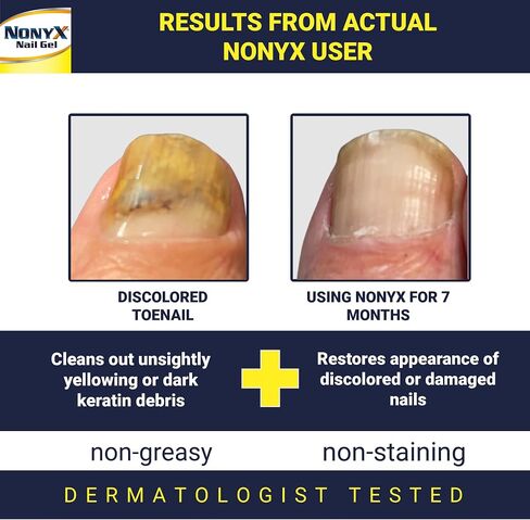 NONYX Fungal Nail Clarifying Gel | Rids Nails of Fungus by Removing Keratin Debris Where Nail Fungus Grows | 90% of Toenails Improved Using this Toenail Fungus Treatment | 4 oz in Saudi Arabia