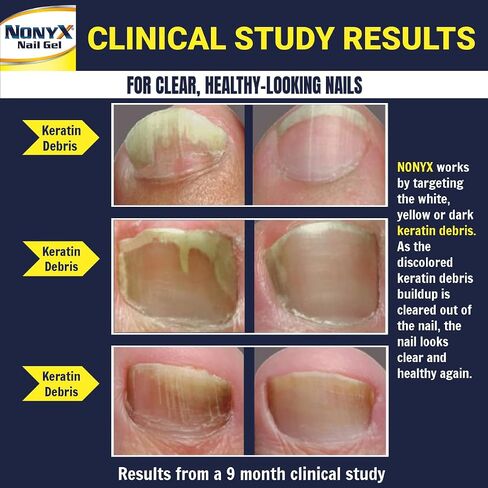 NONYX Fungal Nail Clarifying Gel | Rids Nails of Fungus by Removing Keratin Debris Where Nail Fungus Grows | 90% of Toenails Improved Using this Toenail Fungus Treatment | 4 oz in Saudi Arabia