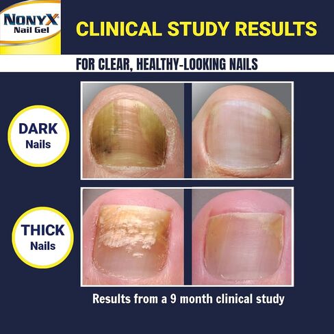 NONYX Fungal Nail Clarifying Gel | Rids Nails of Fungus by Removing Keratin Debris Where Nail Fungus Grows | 90% of Toenails Improved Using this Toenail Fungus Treatment | 4 oz in Saudi Arabia