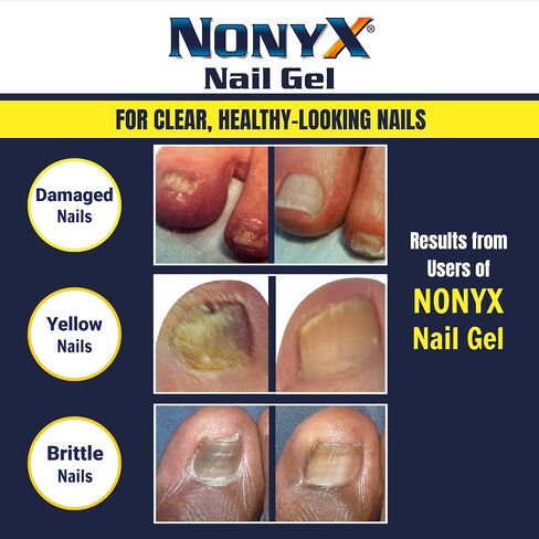 NONYX Fungal Nail Clarifying Gel | Rids Nails of Fungus by Removing Keratin Debris Where Nail Fungus Grows | 90% of Toenails Improved Using this Toenail Fungus Treatment | 4 oz in Saudi Arabia
