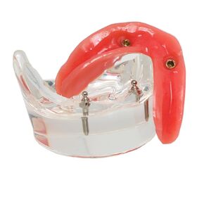 Dental Implant Model, Lower Jaw Overdenture, Removable Overdenture, with 2 Implants,M6002