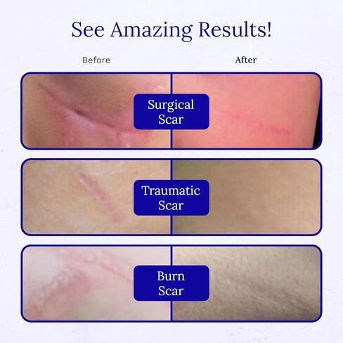 Rejuvaskin Rejuvasil Silicone Scar Gel – Scar Treatment for Surgical Scars for Face, Body, Burn, Keloids, and Acne Scar – Silicone Gel for Scars to Reduced the Appearance of Old & New Scar -30ml in Kuwait