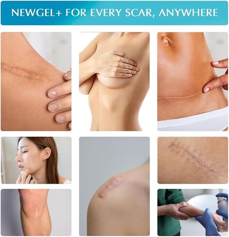 NewGel+ Advanced Silicone Scar Treatment Sheeting for OLD and NEW Scars, for Surgery, Injury, Keloids, C-Section, Burns, and Acne, Reusable, 1" x 6" Sheet (4 Count) - CLEAR in Kuwait