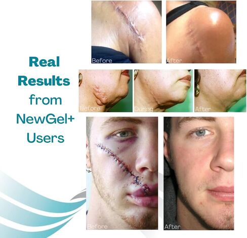 NewGel+ Advanced Silicone Scar Treatment Sheeting for OLD and NEW Scars, for Surgery, Injury, Keloids, C-Section, Burns, and Acne, Reusable, 1" x 6" Sheet (4 Count) - CLEAR in Kuwait
