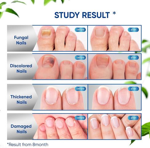 Toenail Fungus Treatment Extra Strength 2pcs x 30ml, Fungus Nail Treatment, Nail Fungus Treatment for Toenail, Toe Nail Fungus Treatment Extra Strength for Damaged and Discoloration Nails. in Saudi Arabia