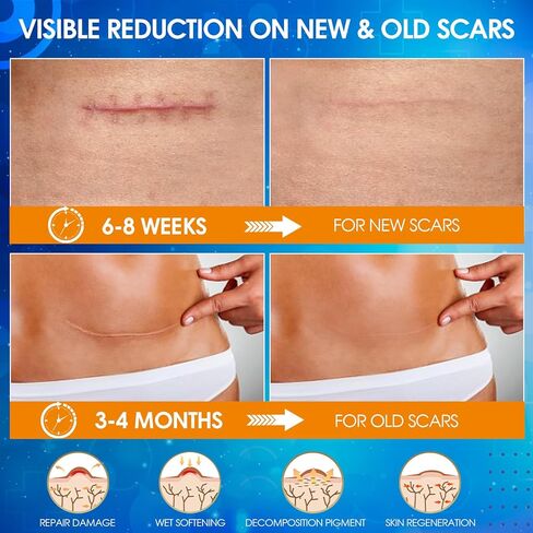 Silicone Scar Tape, Medical Grade Silicone Scar Sheets for Surgical Scars, Soft & Flexiable Size Silicone Strips for C Section, Keloid, Tummy Tuck, Burn, 1.6" X 60" Roll in Kuwait