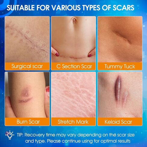 Silicone Scar Tape, Medical Grade Silicone Scar Sheets for Surgical Scars, Soft & Flexiable Size Silicone Strips for C Section, Keloid, Tummy Tuck, Burn, 1.6" X 60" Roll in Kuwait