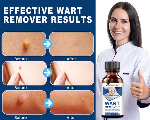 Strongest Wart Corn Remover Mask for Toes Fingers: Foot Wart Corn Removal for Feet Hands - Exclusive Formula Salicylic Acid Wart Off Mask for Plantar Wart, Common Wart, Flat Wart 30ml in Saudi Arabia