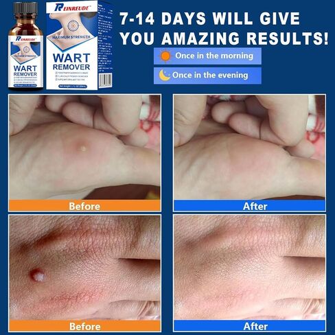 Strongest Wart Corn Remover Mask for Toes Fingers: Foot Wart Corn Removal for Feet Hands - Exclusive Formula Salicylic Acid Wart Off Mask for Plantar Wart, Common Wart, Flat Wart 30ml in Saudi Arabia