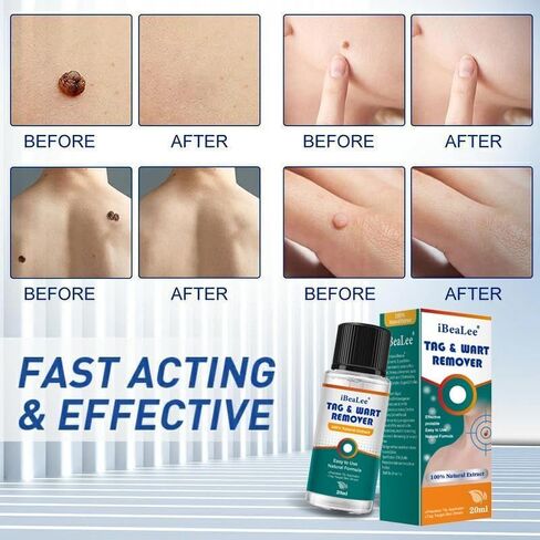 Wart Remover Liquid - 12% Wart Liquid with Salicylic Acid Botanical-Based Formula for Plantar and Common Warts.Suitable for People with Most Skin Types (1pack) in Saudi Arabia