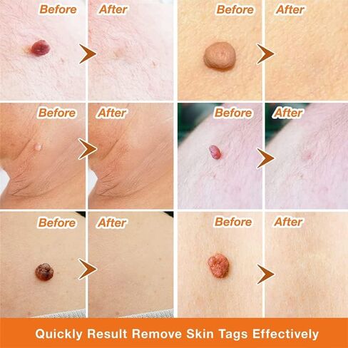 Wart Remover Liquid - 12% Wart Liquid with Salicylic Acid Botanical-Based Formula for Plantar and Common Warts.Suitable for People with Most Skin Types (1pack) in Saudi Arabia