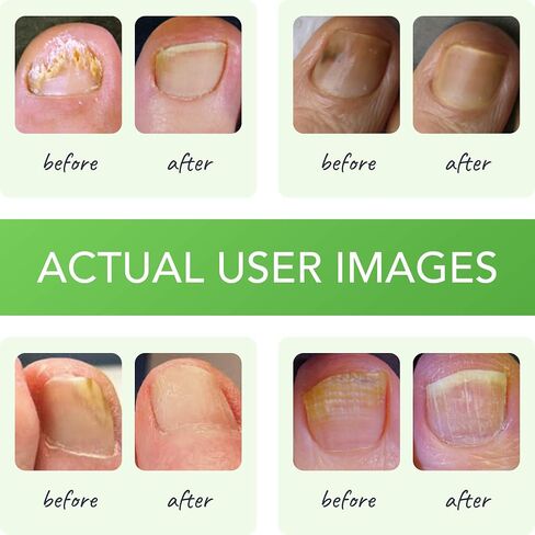 Funginix Toenail Fungus Treatment - أقصى قوة - علاج فطريات الأظافر للأظافر الفطرية - محلول سائل مضاد للفطريات - مصنوع في زجاجة الولايات المتحدة الأمريكية - (قد تختلف التغليف) in Kuwait
