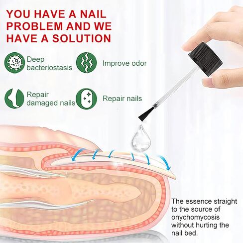 Toenail Fungus Treatment Extra Strength,Fungus Nail Treatment,Nail Fungus Treatment For Toenail,Athletes Foot Treatment,Toe Nail Fungus Treatments For Fungi Nail (1.01Fl Oz (Pack of 1)) in Saudi Arabia