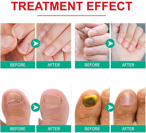 Toenail Fungus Treatment Extra Strength,Fungus Nail Treatment,Nail Fungus Treatment For Toenail,Athletes Foot Treatment,Toe Nail Fungus Treatments For Fungi Nail (1.01Fl Oz (Pack of 1)) in Saudi Arabia