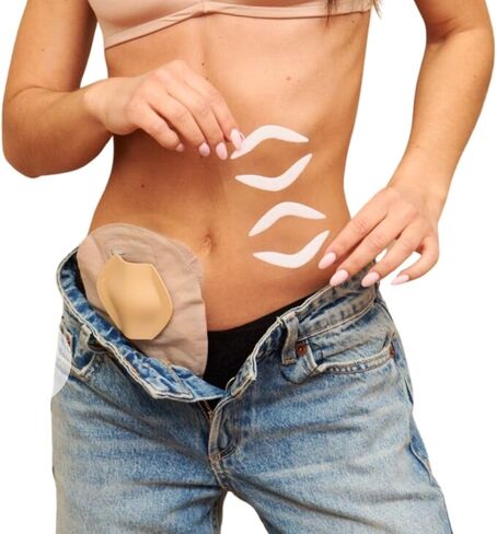 Siil Stoma Guard Shield لأكياس الفتيل. حماية أكياس فغر القولون الخاصة بك وإمدادات فغر اللفائفي مع حامي ستوما | غطاء ستوما in Kuwait