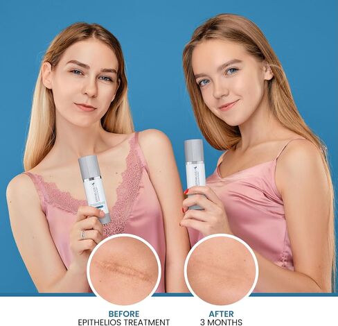 علاج Epithelios المتقدم للندبات بدون عامل حماية من الشمس (SPF) - متوافق مع المكياج والكريمات، جل السيليكون ذاتي الالتصاق - مرطب وينعم ويحمي الندبات - لعلامات التمدد وحب الشباب والندبات القديمة والجديدة - 30 مل in Saudi Arabia
