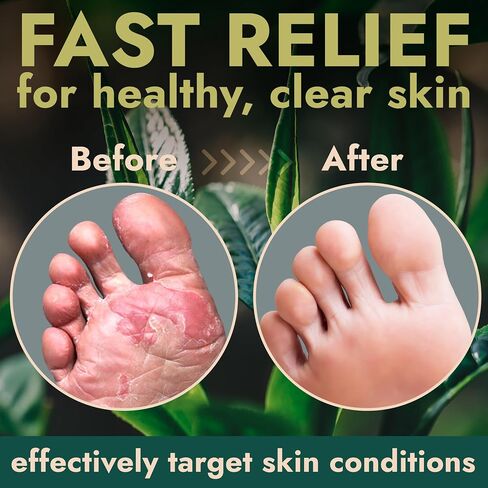 Terramed Just Think Comfort Foot Spray with Tea Tree Oil | Antifungal Treatment for Jock Itch, Nail Fungus & Ringworm | Fast Absorbing & Deep Penetrating Relief | Soothes Itching & Burning | 120ml in Kuwait
