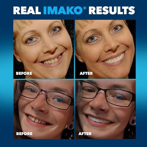 Imako Premium Cosmetic Uppers - 1 Pack - Small, Bleached White - DIY Smile Makeover - Made in USA in Saudi Arabia