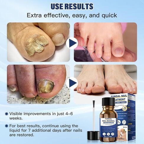 Toenail Fungus Treatment Extra Strength,Nail Fungus Treatment For Toenail,Athletes Foot Treatment,Ingrown Toenail Treatment,Toe Nail Fungus Treatments For Fungi Nail(1fl oz/30ml) in Saudi Arabia