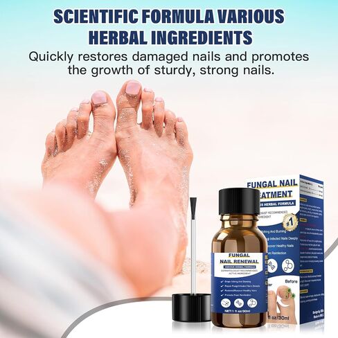 Toenail Fungus Treatment Extra Strength,Nail Fungus Treatment For Toenail,Athletes Foot Treatment,Ingrown Toenail Treatment,Toe Nail Fungus Treatments For Fungi Nail(1fl oz/30ml) in Saudi Arabia