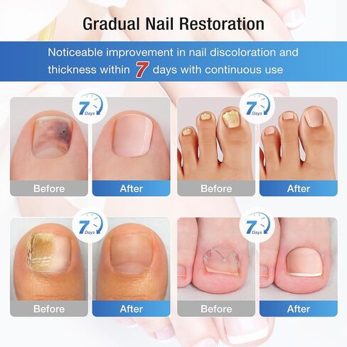 Toenail Fungus Treatment Extra Strength Kit - 30ml Nail Repair Liquid Solution and 20 Hydrogel Patches, Nighttime Fungal Nail Treatment for Toe & Fingers, Fast-Acting Formula in Saudi Arabia